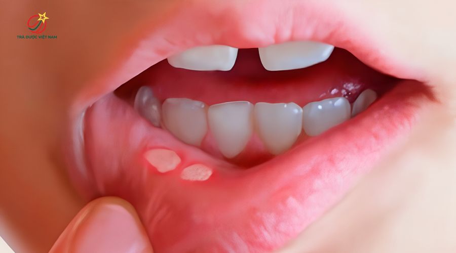 Nụ hoa còn giúp hỗ trợ ngăn ngừa và giảm viêm loét miệng